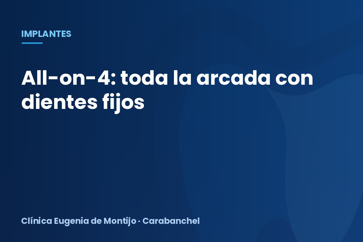 All-on-4: una arcada completa de dientes fijos sobre implantes