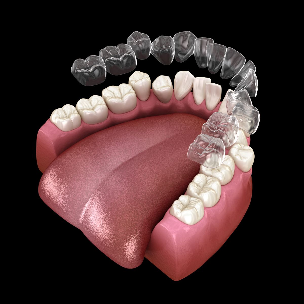 ¿Cuánto dura un tratamiento de Invisalign?