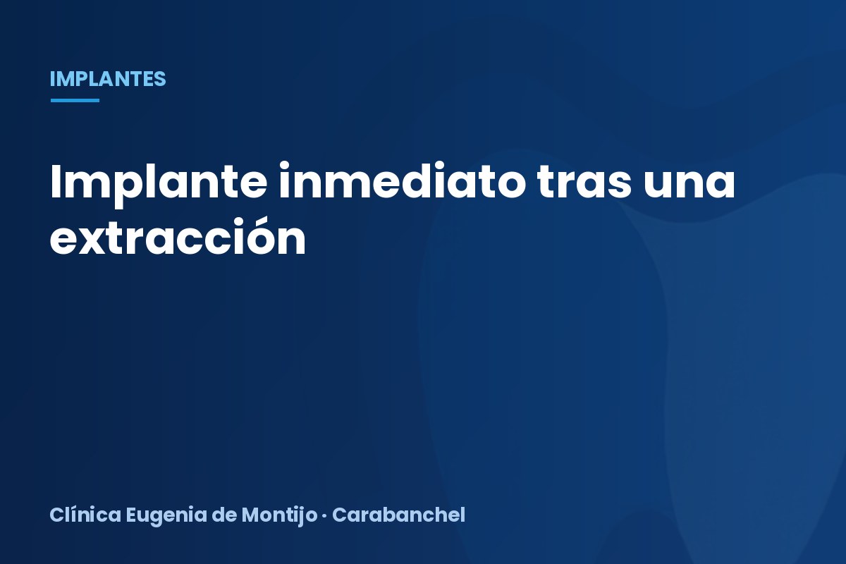Implante inmediato tras la extracción: ¿se puede poner ya?