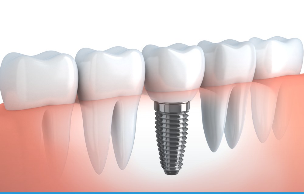 Implantes sin dolor: así lo conseguimos