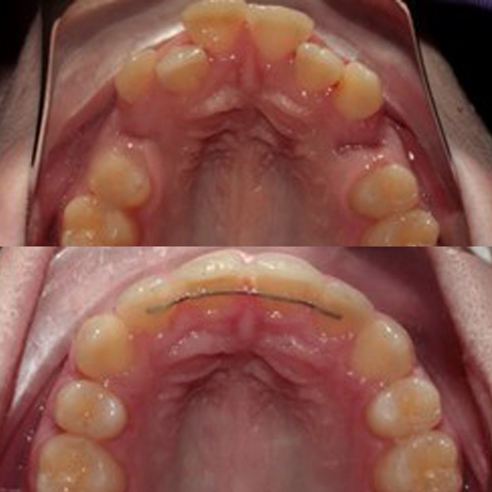 Invisalign vs brackets: ¿cuál es mejor para ti?