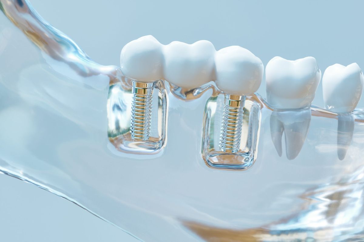 ¿Cuánto cuesta un implante dental en Carabanchel?