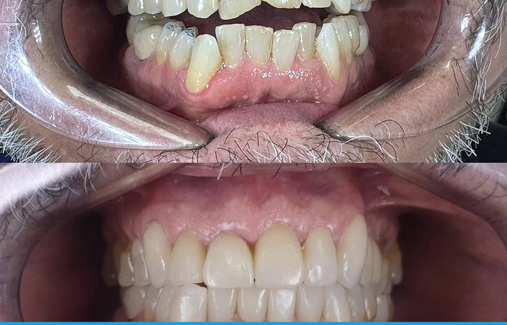 Tipos de brackets: metálicos, estéticos y linguales