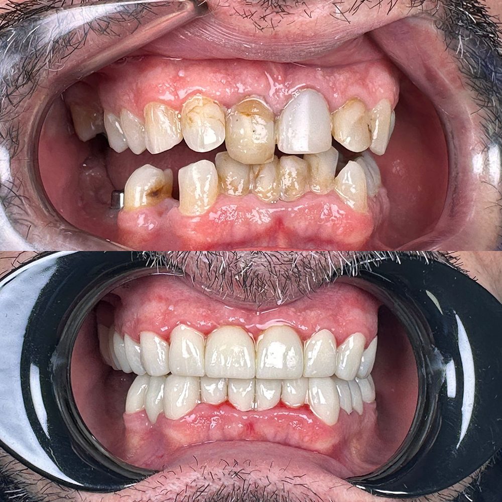 Antes y después de tratamiento dental en Carabanchel