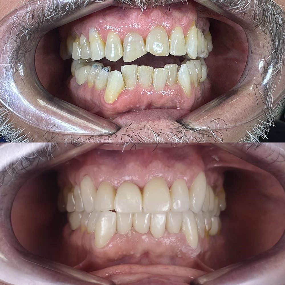 Antes y después de diseño de sonrisa en Carabanchel