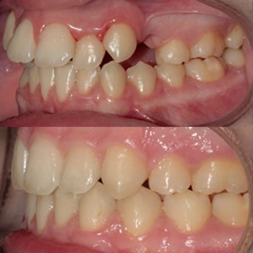 Antes y después: sonrisa transformada con ortodoncia en Carabanchel