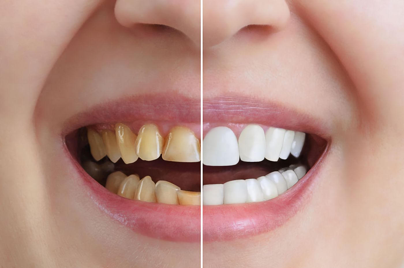 Blanqueamiento y estética dental en Carabanchel