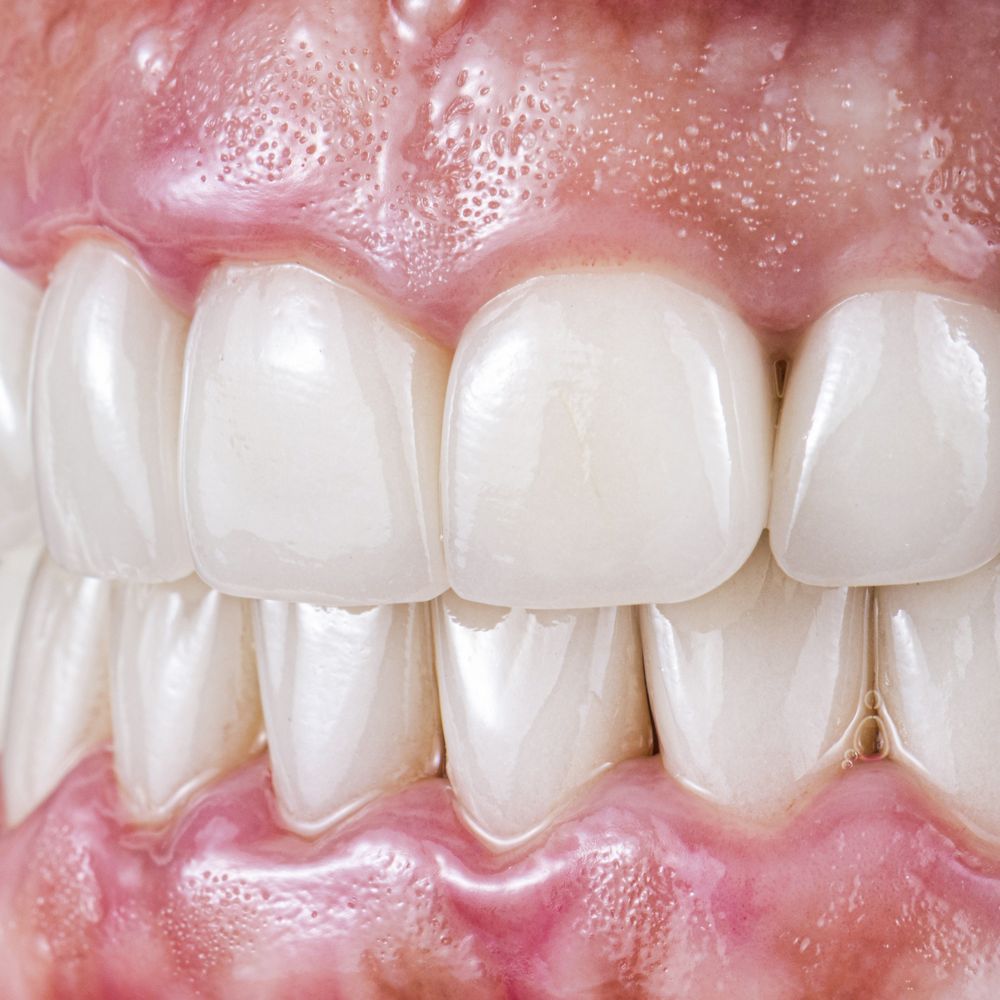 Resultado natural de estética dental: dientes blancos y sanos en Carabanchel