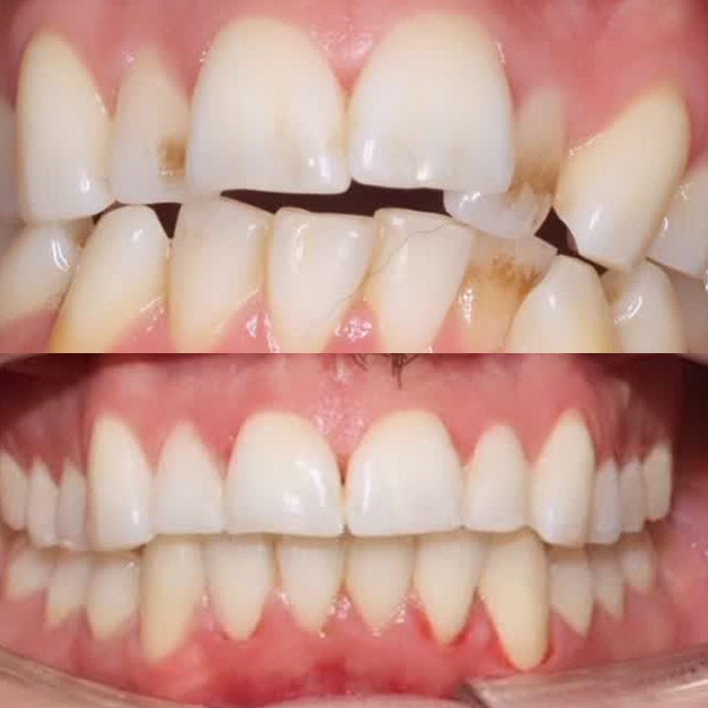 Caso clínico de ortodoncia con Invisalign antes y después en Carabanchel - Clínica Eugenia de Montijo