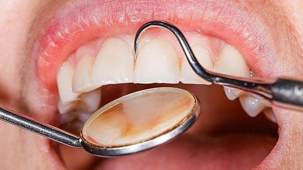 La gingivitis y la periodontitis no están causadas por las mismas bacterias