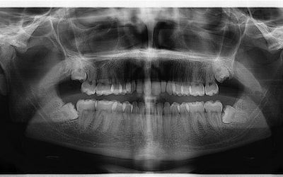 Investigadores españoles desarrollan un líquido capaz de frenar la progresión de la periodontitis
